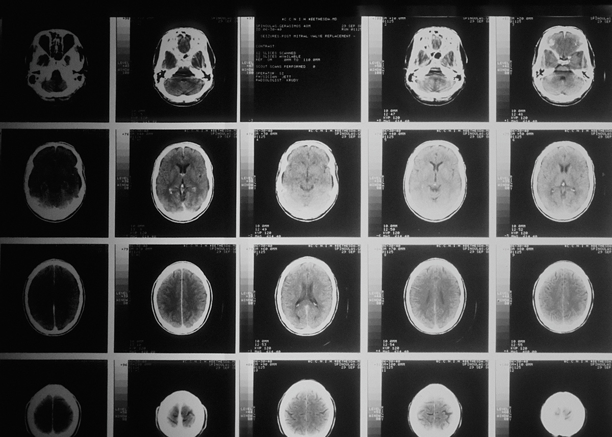 CT扫描的大脑